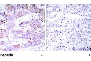 Immunohistochemical analysis of paraffin-embedded human breast carcinoma using ELK1 polyclonal antibody . (ELK1 antibody)