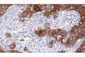 ABIN6277037 at 1/100 staining Human Head and neck cancer tissue by IHC-P. (CD83 antibody  (Internal Region))