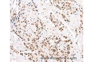 Immunohistochemistry of Human prostate cancer using CTBP2 Polyclonal Antibody at dilution of 1:40