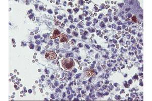 Immunohistochemical staining of paraffin-embedded Adenocarcinoma of Human colon tissue using anti-SDS mouse monoclonal antibody. (serine Dehydratase antibody)