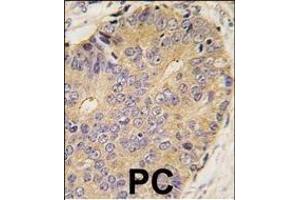 Formalin-fixed and paraffin-embedded human prostata carcinoma tissue reacted with B antibody (Center) (ABIN388450 and ABIN2848765) , which was peroxidase-conjugated to the secondary antibody, followed by DAB staining. (BMP15 antibody  (AA 241-271))