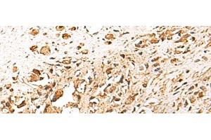 Immunohistochemistry of paraffin-embedded Human prost ate cancer tissue using TERF1 Polyclonal Antibody at dilution of 1:30(x200)