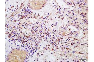 Formalin-fixed and paraffin embedded human bladder carcinoma labeled with Anti-CD158 Polyclonal Antibody, Unconjugated (ABIN748463) at 1:200 followed by conjugation to the secondary antibody and DAB staining. (KIR2DL4/CD158d antibody  (AA 51-150))