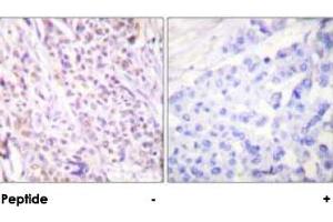 Immunohistochemical analysis of paraffin-embedded human breast carcinoma tissue using RAD17 polyclonal antibody . (RAD17 antibody)