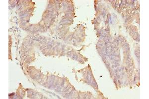 Immunohistochemistry of paraffin-embedded human endometrial cancer using ABIN7166006 at dilution of 1:100 (RER1 antibody  (AA 85-139))