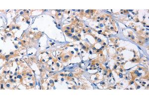 Immunohistochemistry of paraffin-embedded Human thyroid cancer using CAPZA2 Polyclonal Antibody at dilution of 1:30 (CAPZA2 antibody)