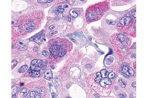 Anti-MRGPRF antibody IHC of human Ovary, Carcinoma. (Mrgprf antibody  (C-Term))
