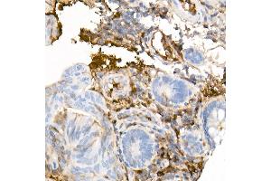 Immunohistochemistry of paraffin-embedded Human colon carcinoma using Human IgG antibody (ABIN7267844) at dilution of 1:300 (40x lens). (IGHG1 antibody)