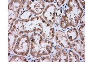 Immunohistochemical staining of paraffin-embedded Carcinoma of liver tissue using anti-NME4 mouse monoclonal antibody. (NME4 antibody)
