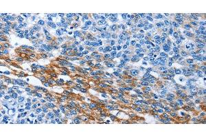 Immunohistochemistry of paraffin-embedded Human ovarian cancer tissue using PAK6 Polyclonal Antibody at dilution 1:40 (PAK6 antibody)