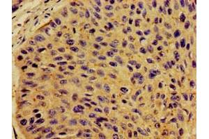 Immunohistochemistry of paraffin-embedded human cervical cancer using ABIN7149290 at dilution of 1:100 (CD131 antibody  (AA 492-710))