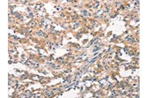 The image on the left is immunohistochemistry of paraffin-embedded Human thyroid cancer tissue using ABIN7193053(WNK3 Antibody) at dilution 1/20, on the right is treated with synthetic peptide. (WNK3 antibody)
