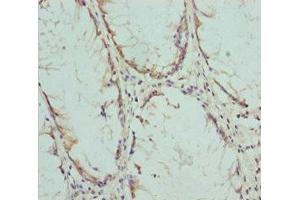Immunohistochemistry of paraffin-embedded human colon cancer using ABIN7148459 at dilution of 1:100 (COG5 antibody  (AA 1-260))