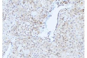 ABIN6275233 at 1/100 staining Human lung cancer tissue by IHC-P.
