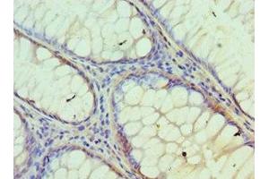 Immunohistochemistry of paraffin-embedded human colon cancer using ABIN7157125 at dilution of 1:100 (IDH2 antibody  (AA 193-452))