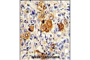 Formalin-fixed and paraffin-embedded human breast carcinoma with C5 Antibody (N-term), which was peroxidase-conjugated to the secondary antibody, followed by DAB staining. (C5 antibody  (N-Term))