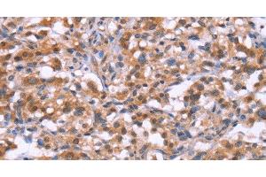 Immunohistochemistry of paraffin-embedded Human thyroid cancer tissue using BRK1 Polyclonal Antibody at dilution 1:30 (BRK1 antibody)