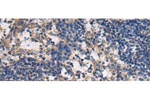 Immunohistochemistry of paraffin-embedded Human esophagus cancer tissue using DMRTA2 Polyclonal Antibody at dilution of 1:50(x200) (DMRTA2 antibody)
