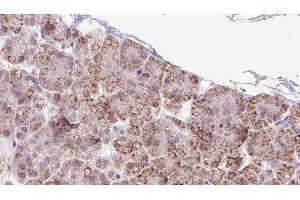 ABIN6273246 at 1/100 staining Human pancreas cancer tissue by IHC-P. (FXR1 antibody  (Internal Region))