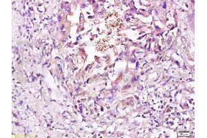 Formalin-fixed and paraffin embedded human esophageal carcinoma labeled with Rabbit Anti CD56/NCAM1 Polyclonal Antibody, Unconjugated (ABIN728398) at 1:200 followed by conjugation to the secondary antibody and DAB staining (CD56 antibody  (AA 621-720))