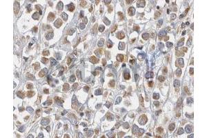 ABIN6268680 at 1/100 staining human breast tissues sections by IHC-P. (alpha Fetoprotein antibody  (C-Term))