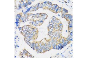 Immunohistochemistry of paraffin-embedded Human colon carcinoma using RPL35 Rabbit pAb (ABIN7270004) at dilution of 1:100 (40x lens). (RPL35 antibody  (AA 50-120))