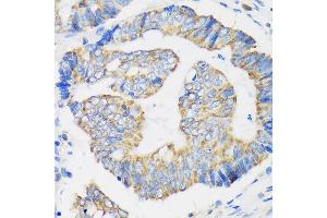 Immunohistochemistry of paraffin-embedded Human colon carcinoma using RPL35 Rabbit pAb (ABIN7270004) at dilution of 1:100 (40x lens).