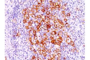Formalin-fixed, paraffin-embedded human Hodgkin's lymphoma stained with CD30 Ab (CD30/412). (TNFRSF8 antibody)