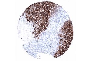 Follicular thyroid cancer with strong thyroglobulin expression (Recombinant Thyroglobulin antibody)