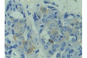 Detection of CAPS in Human Breast cancer Tissue using Polyclonal Antibody to Calcyphosine (CAPS) (Calcyphosine antibody  (AA 1-189))