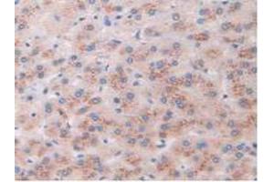 IHC-P analysis of Human Liver Cancer Tissue, with DAB staining. (AKAP11 antibody  (AA 1650-1901))