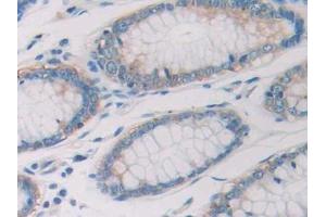 DAB staining on IHC-P; Samples: Human Colorectal cancer Tissue (Ribonuclease A10 (AA 27-216) antibody)