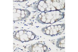 Immunohistochemistry of paraffin-embedded human colon using TNNC2 antibody (ABIN6129604, ABIN6149353, ABIN6149354 and ABIN6223680) at dilution of 1:200 (40x lens). (TNNC2 antibody  (AA 1-160))