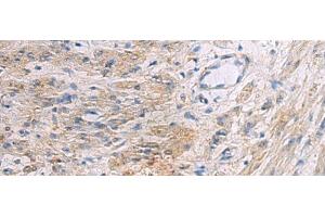 Immunohistochemistry of paraffin-embedded Human gastric cancer tissue using SLC30A3 Polyclonal Antibody at dilution of 1:55(x200) (Slc30a3 antibody)