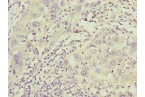 Immunohistochemistry of paraffin-embedded human liver cancer using ABIN7156977 at dilution of 1:100 (IFT20 antibody  (AA 1-132))