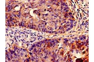 Immunohistochemistry analysis of human cervical cancer using ABIN7156687 at dilution of 1:100 (IFITM3 antibody  (AA 1-57))
