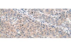 Immunohistochemistry of paraffin-embedded Human liver cancer tissue using SEMA4D Polyclonal Antibody at dilution of 1:60(x200) (SEMA4D/CD100 antibody)