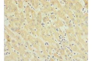 Immunohistochemistry of paraffin-embedded human liver cancer using ABIN7173293 at dilution of 1:100 (TMEM91 antibody  (AA 1-97))