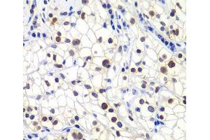 Immunohistochemistry of paraffin-embedded Human kidney cancer using GTF2F2 Polyclonal Antibody at dilution of 1:200 (40x lens). (GTF2F2 antibody)