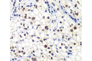 Immunohistochemistry of paraffin-embedded Human kidney cancer using GTF2F2 Polyclonal Antibody at dilution of 1:200 (40x lens). (GTF2F2 antibody)