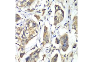 Immunohistochemistry of paraffin-embedded human liver cancer using NFS1 antibody.