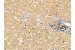 ABIN6258993 and ABIN6276090 at 1/100 staining human hepatocellular carcinoma by IHC-P.