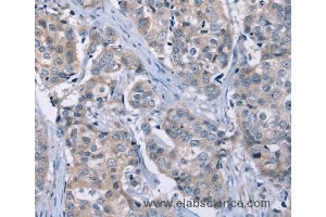 Immunohistochemistry of Human breast cancer using KCNQ5 Polyclonal Antibody at dilution of 1:30