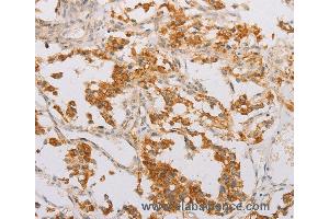 Immunohistochemistry of Human lung cancer using STK40 Polyclonal Antibody at dilution of 1:40 (STK40 antibody)