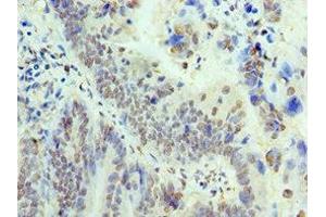 Immunohistochemistry of paraffin-embedded human colon cancer using ABIN7172050 at dilution of 1:100 (THOC1 antibody  (AA 428-657))