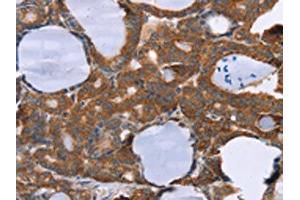 The image on the left is immunohistochemistry of paraffin-embedded Human thyroid cancer tissue using ABIN7130635(PITPNM1 Antibody) at dilution 1/40, on the right is treated with fusion protein.
