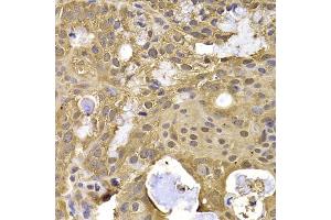Immunohistochemistry of paraffin-embedded human oophoroma using NAA20 antibody (ABIN5974272) at dilution of 1/100 (40x lens). (NAT5 antibody)