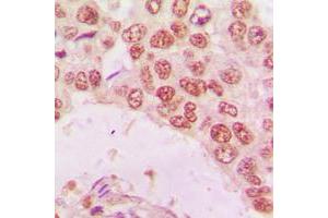 Immunohistochemical analysis of Histone Deacetylase 10 staining in human lung cancer formalin fixed paraffin embedded tissue section. (HDAC10 antibody  (N-Term))