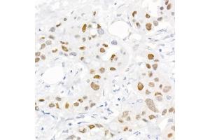 Immunohistochemistry of paraffin-embedded human breast cancer using Phospho-c-Jun-S73 Rabbit pAb (ABIN3023567, ABIN3023568, ABIN3023569 and ABIN6225411) at dilution of 1:25 (40x lens). (C-JUN antibody  (pSer73))