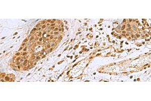 Immunohistochemistry of paraffin-embedded Human esophagus cancer tissue using NVL Polyclonal Antibody at dilution of 1:80(x200) (NVL antibody)